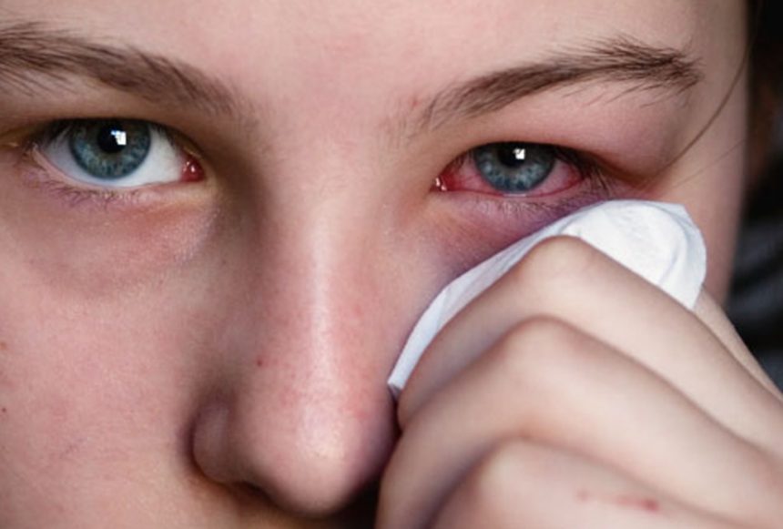 Atenção às alergias oculares típicas do inverno