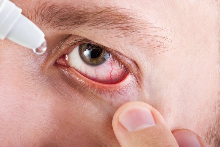 Alergias oculares: tratamento e cuidados importantes para evitá-las