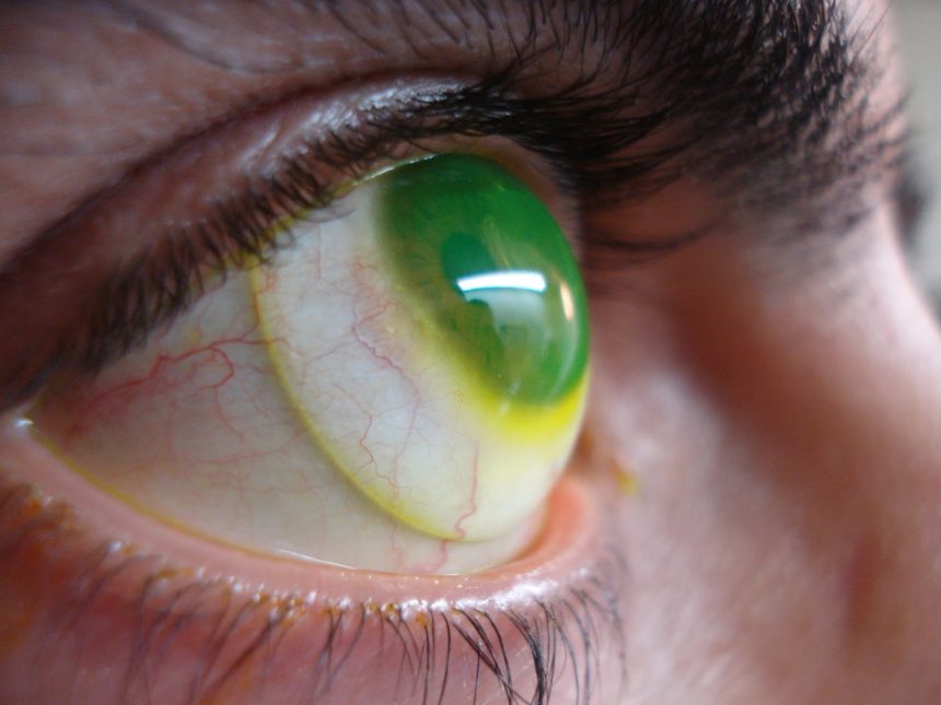 Ceratocone: saiba mais sobre a doença que deixa os olhos pontiagudos