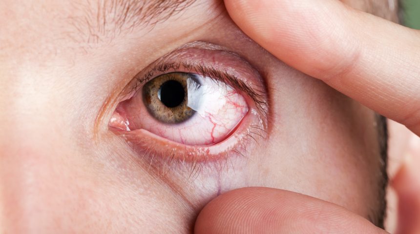 Crise de alergia ocular durante a viagem
