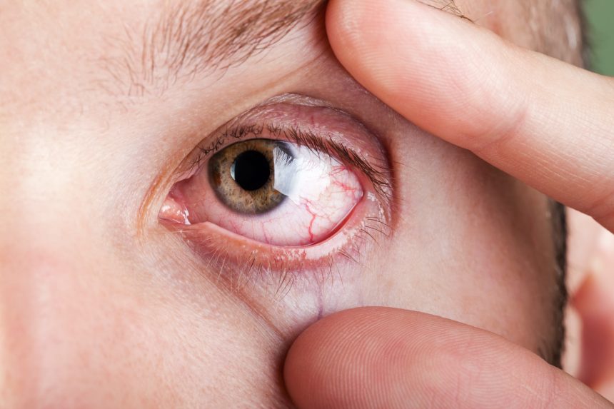 Crise de alergia ocular durante a viagem
