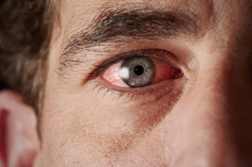 Ceratite Microbiana: doença ocular que pode levar à cegueira, se não tratada!