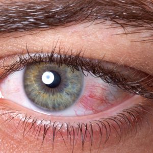 Alergias oculares: a prevenção como base do tratamento