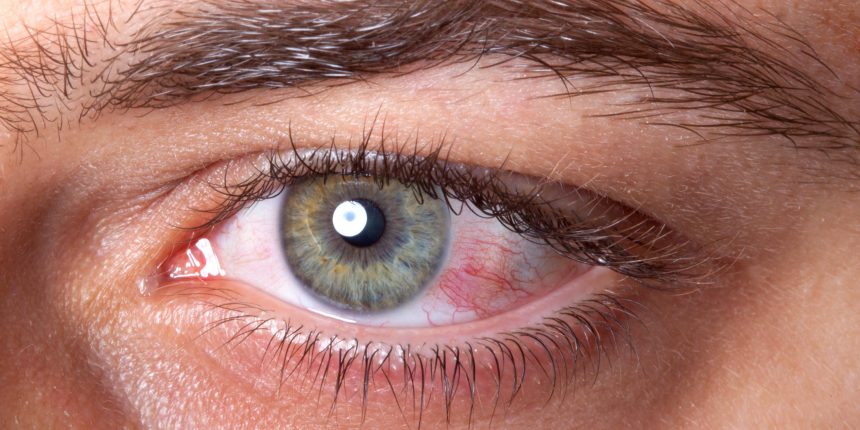 Alergias oculares: a prevenção como base do tratamento