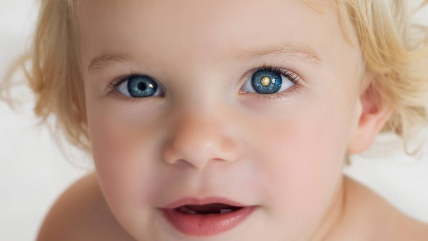 Retinoblastoma: oftalmologistas alertam população sobre cuidados com a saúde ocular das crianças