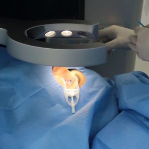 Saiba mais sobre o Streamlight – nova técnica de cirurgia refrativa a laser