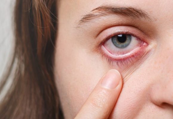 Olho seco: lavar o olho com água ajuda?